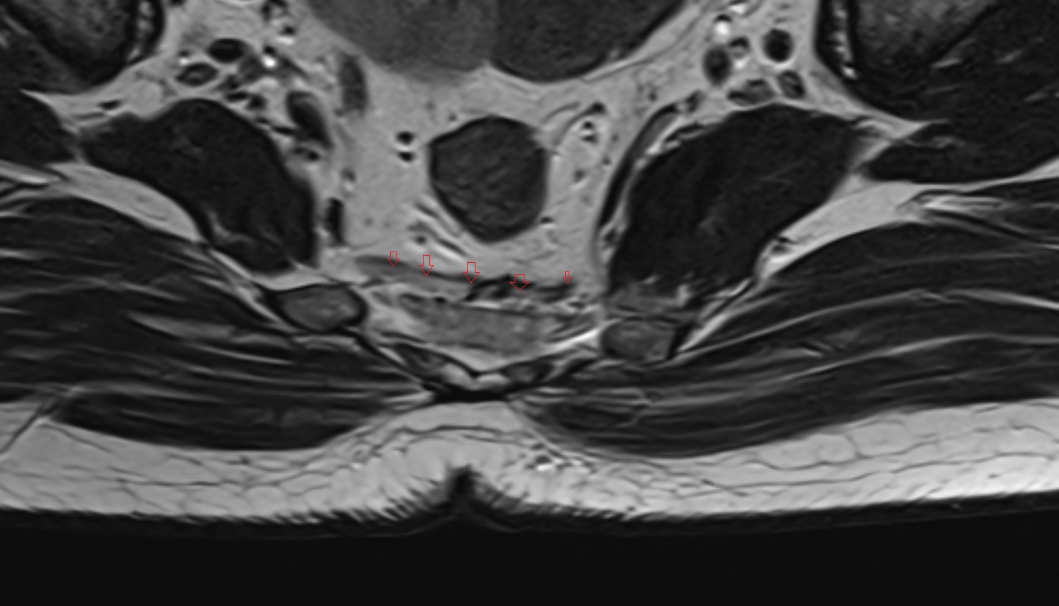 Sacral venous plexus  mri  axial  anatomy  image-img-00000-00000_00001