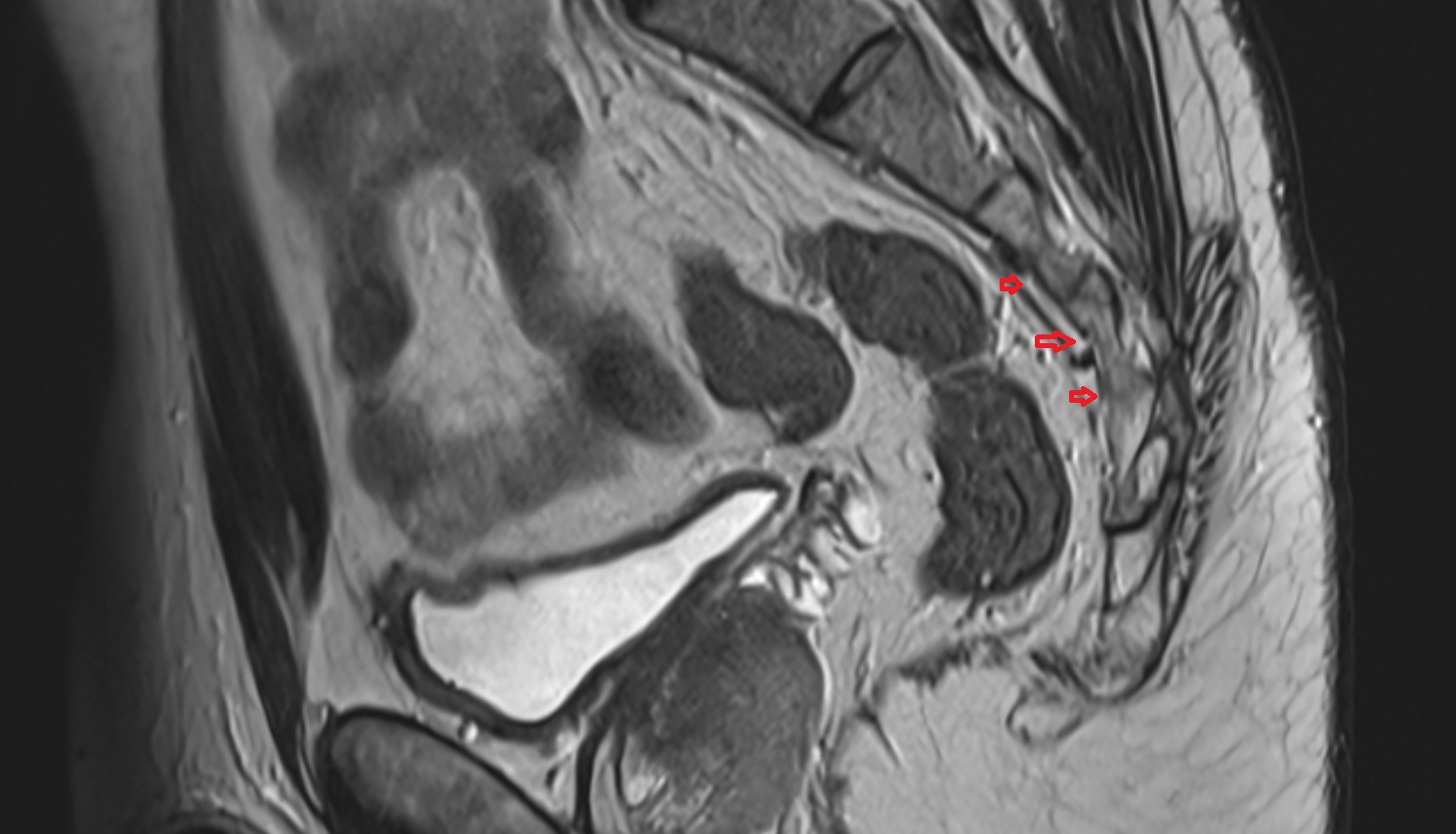 Sacral venous plexus  mri sag  anatomy  image-img-00000-00000