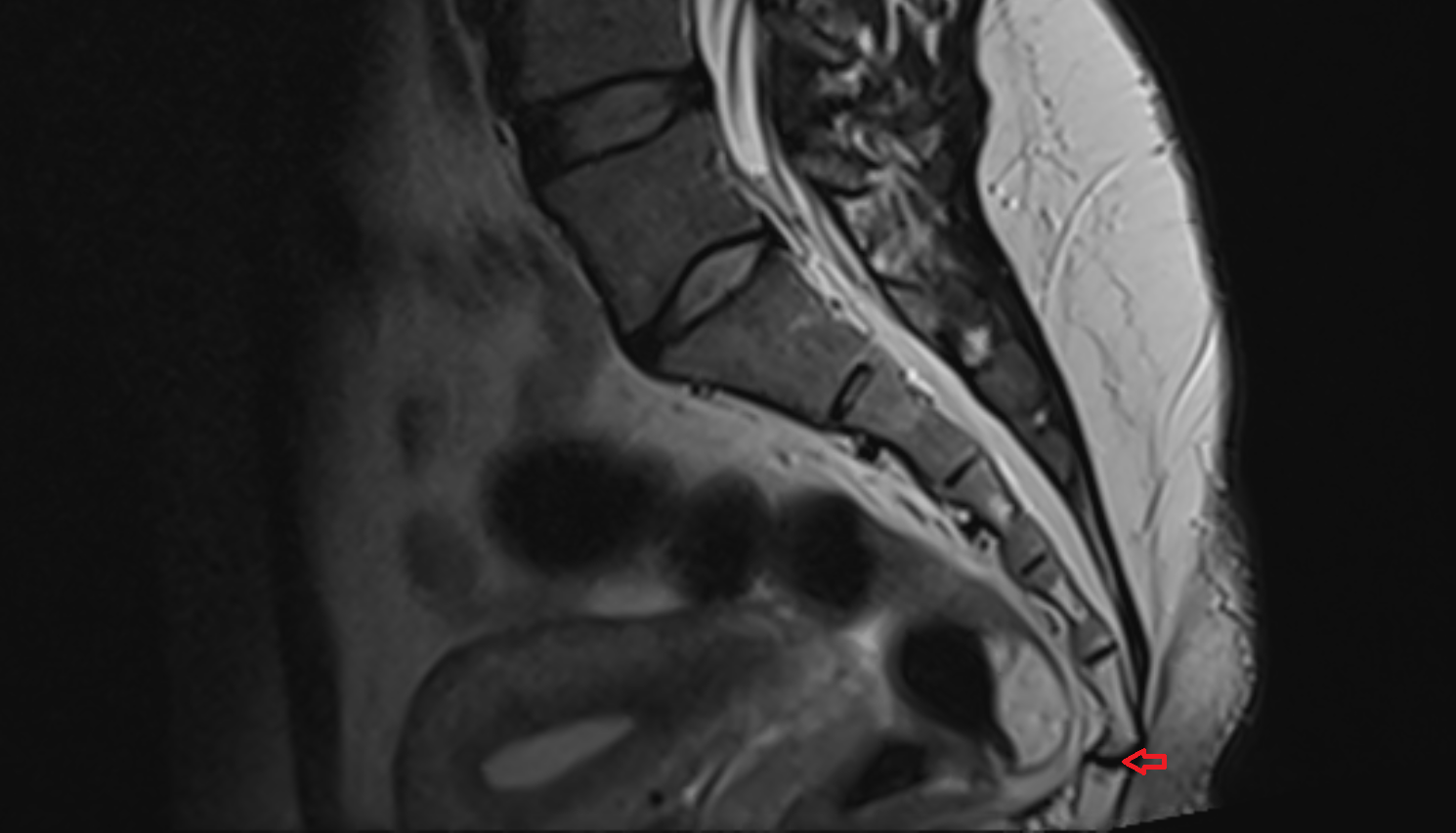 Sacrococcygeal joint mri anatomy  Location and Imaging Appearance  -img-00000-00000_00001