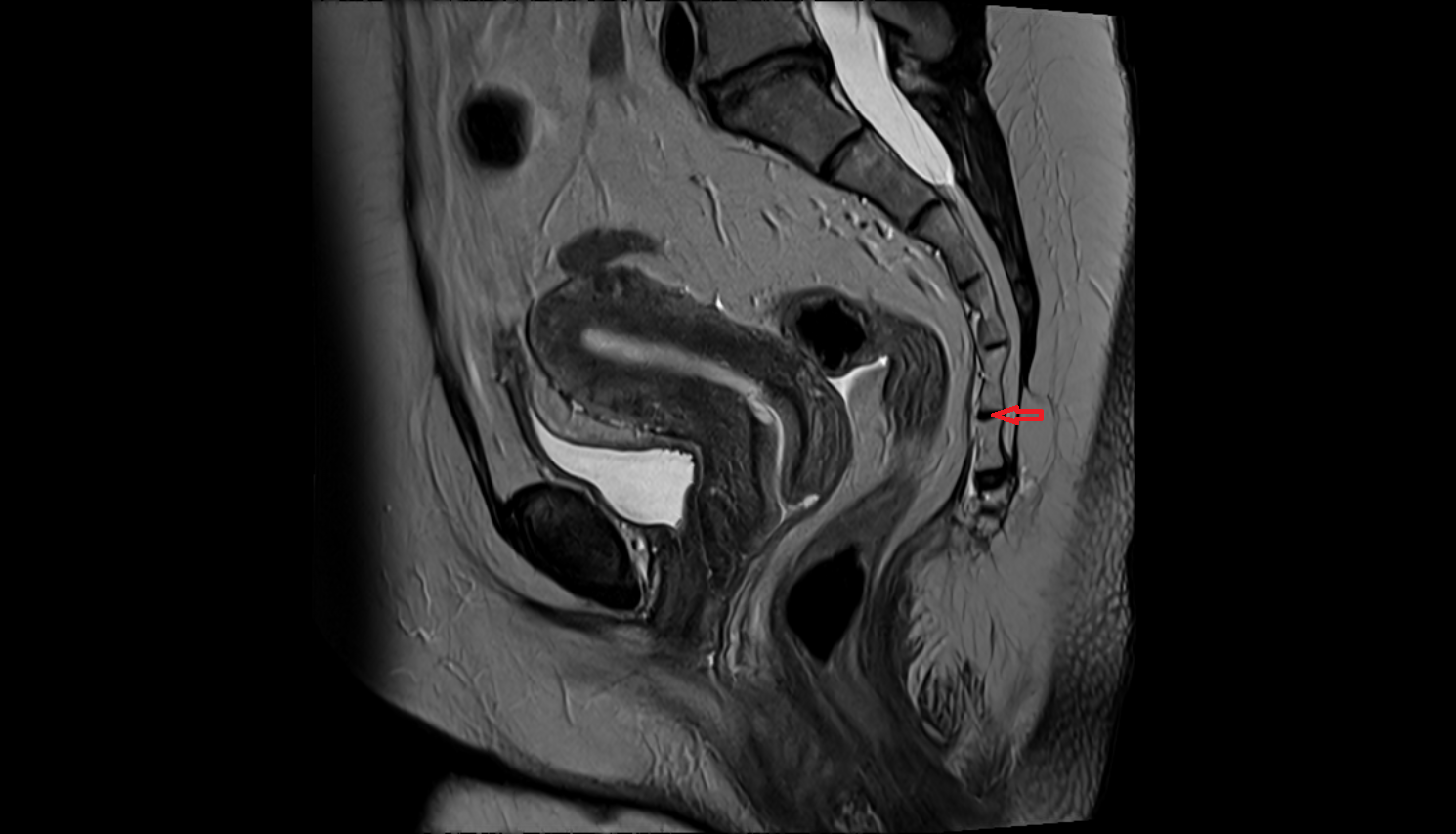 Sacrococcygeal joint mri anatomy  Location and Imaging Appearance  -img-00000-00000_00002