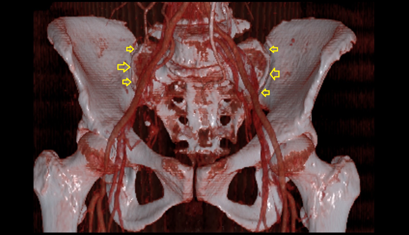 Sacroiliac joint CT  3D image