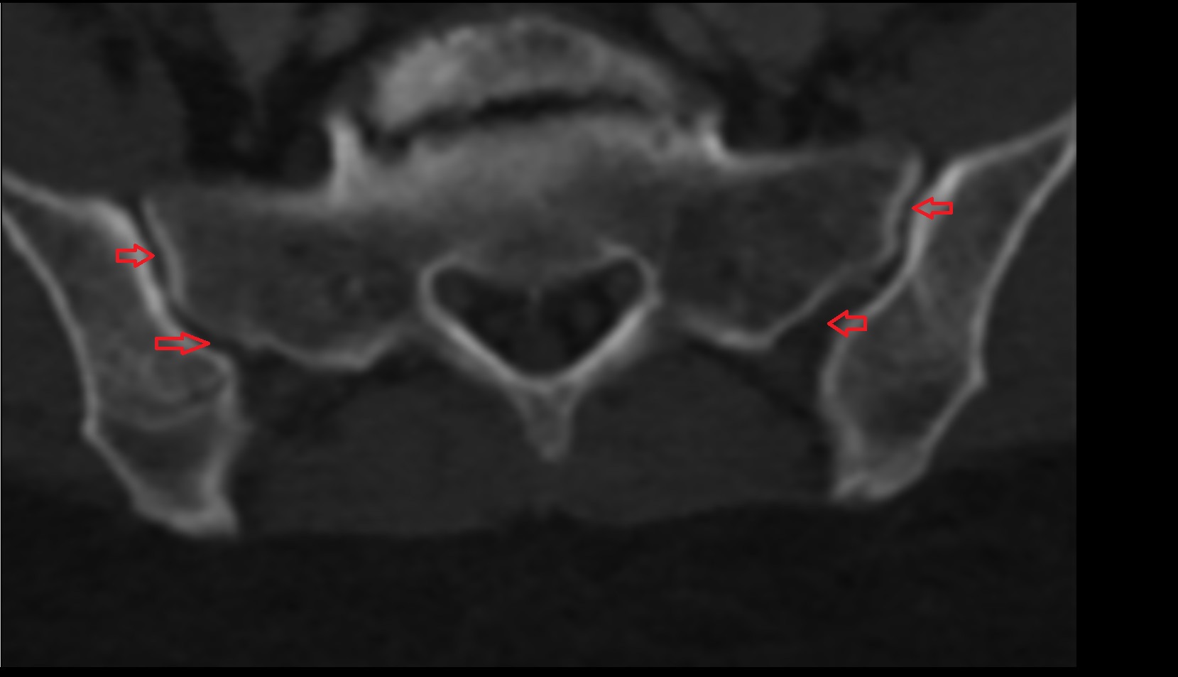 Sacroiliac joint CT axial image
