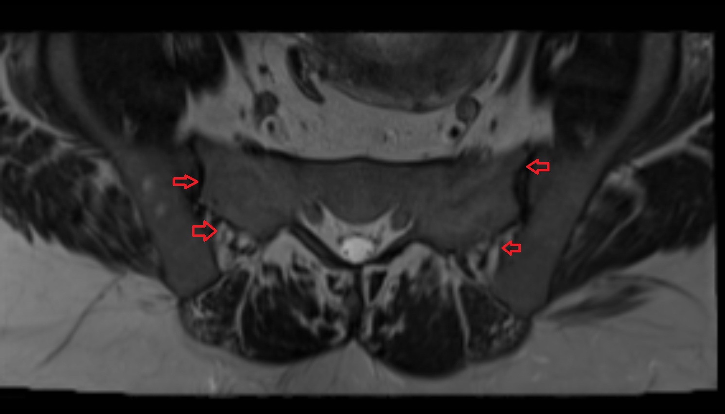 Sacroiliac joint  MRI axial  anatomy  image -img-00000-00000