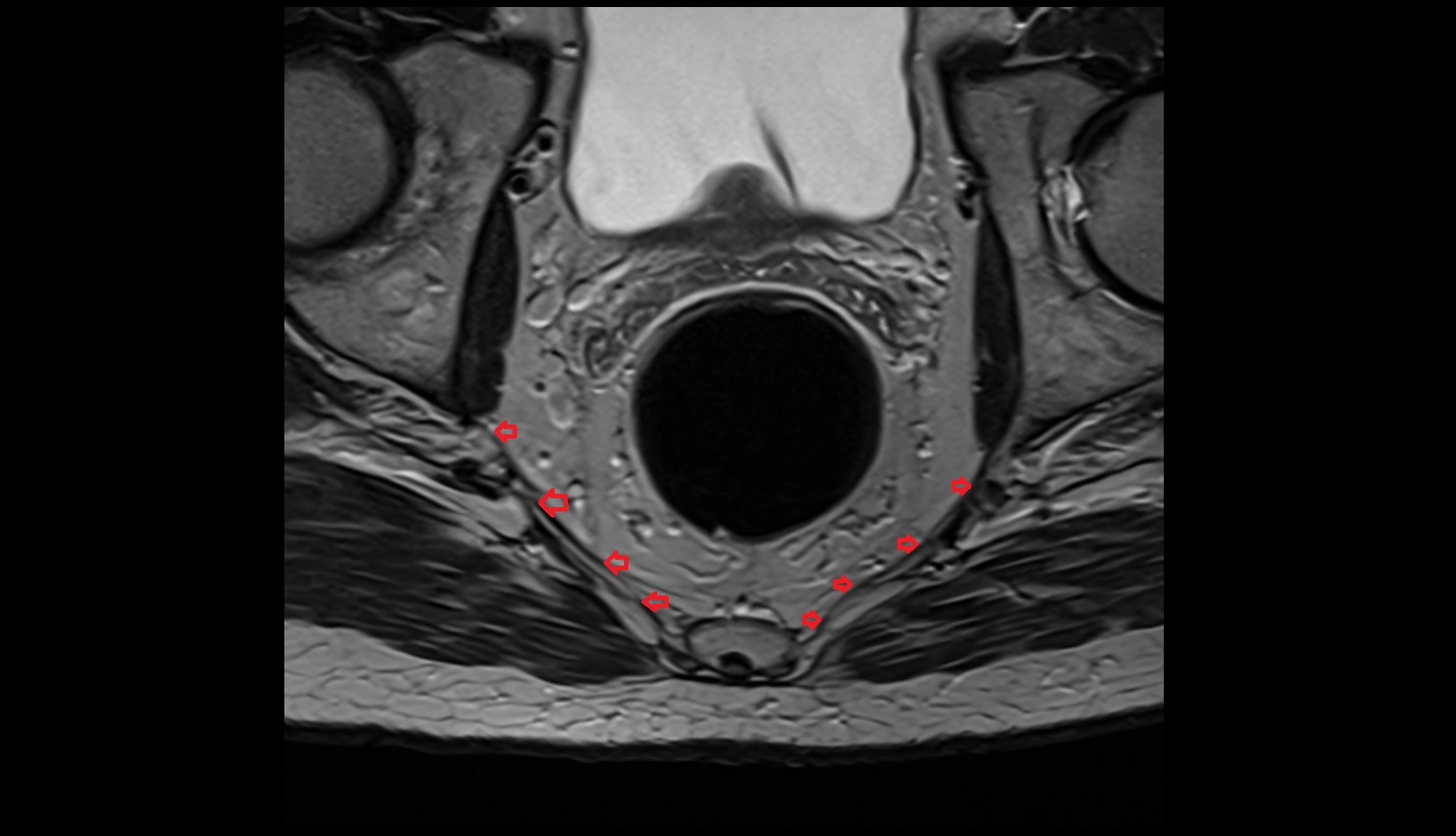 Sacrospinous ligament MRI axial image