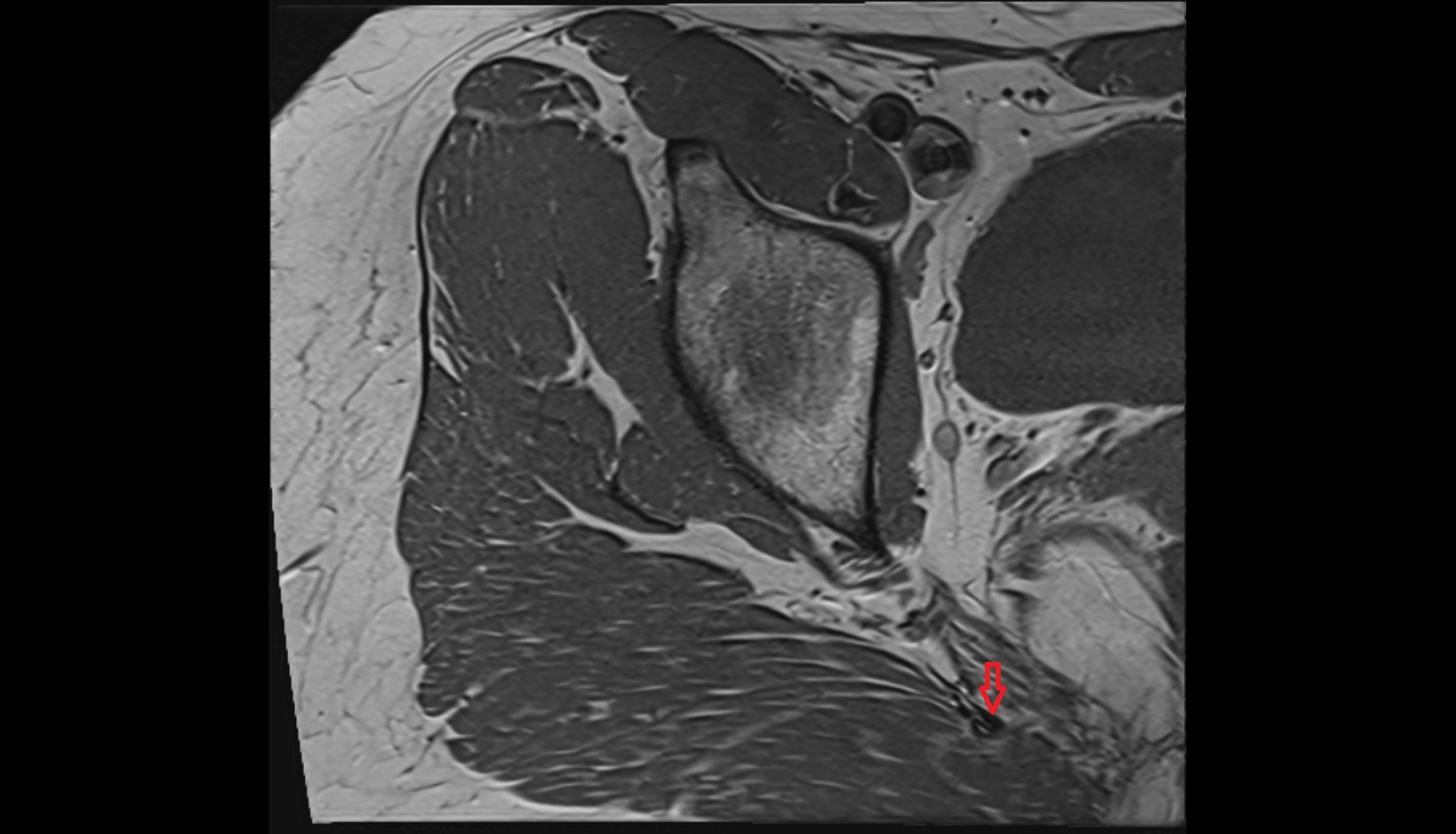 Sacrospinous ligament  MRI sagl  anatomy image-img-00000-00000