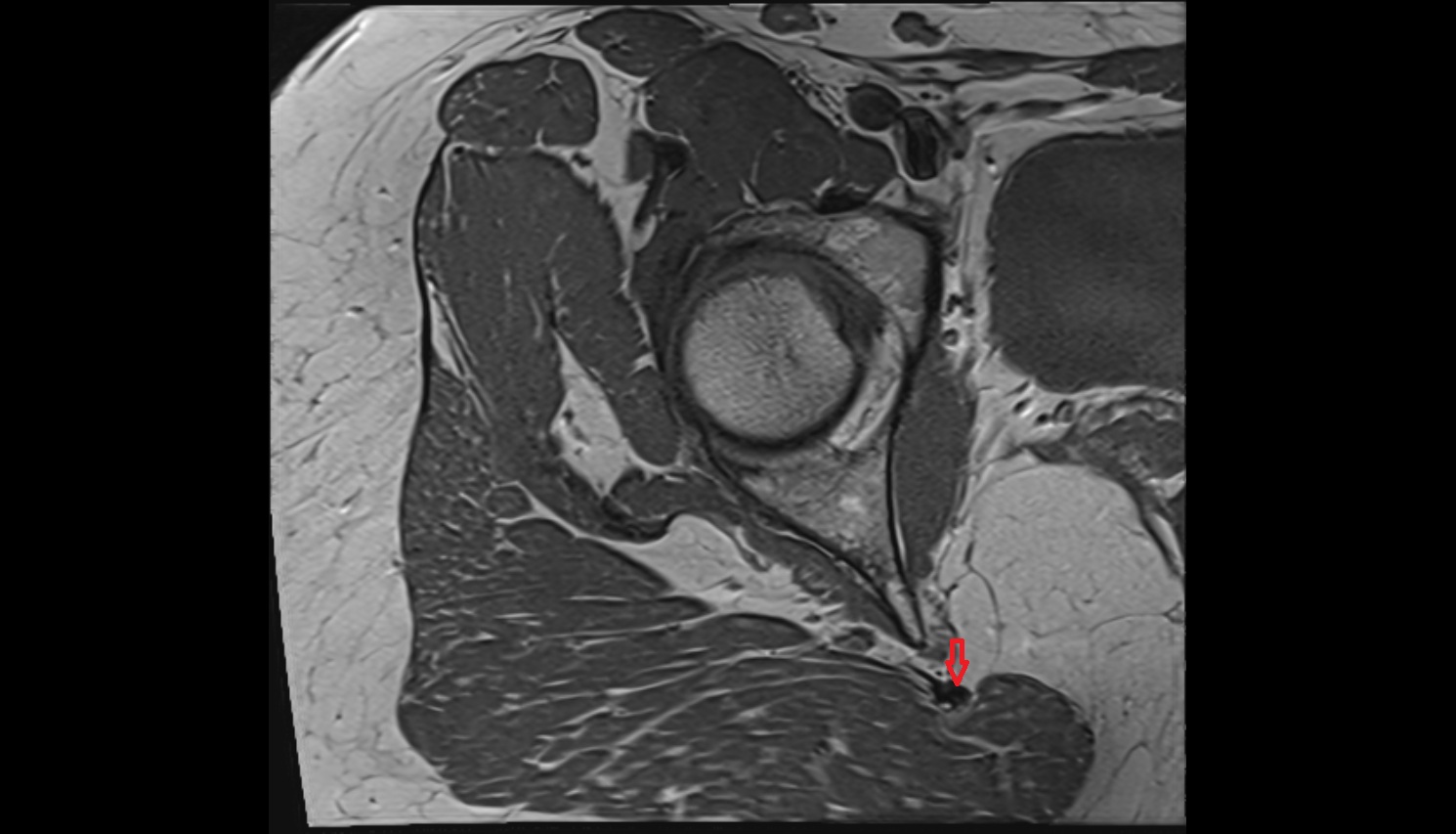 Sacrospinous ligament  MRI sagl  anatomy image-img-00000-00000_00001
