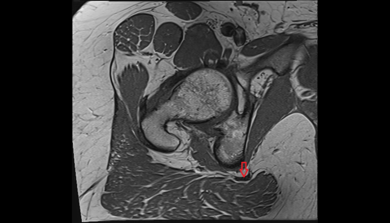 Sacrospinous ligament  MRI sagl  anatomy image-img-00000-00000_00002