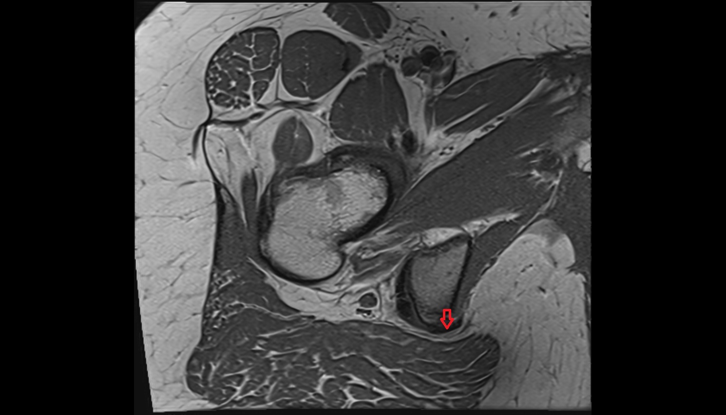 Sacrospinous ligament  MRI sagl  anatomy image-img-00000-00000_00003