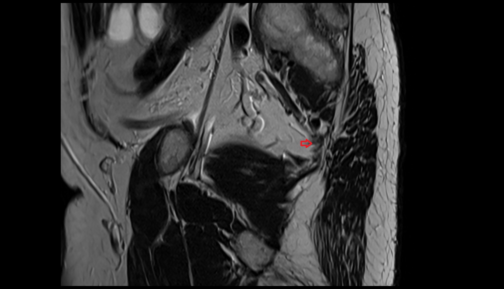 Sacrospinous ligament sag mri image