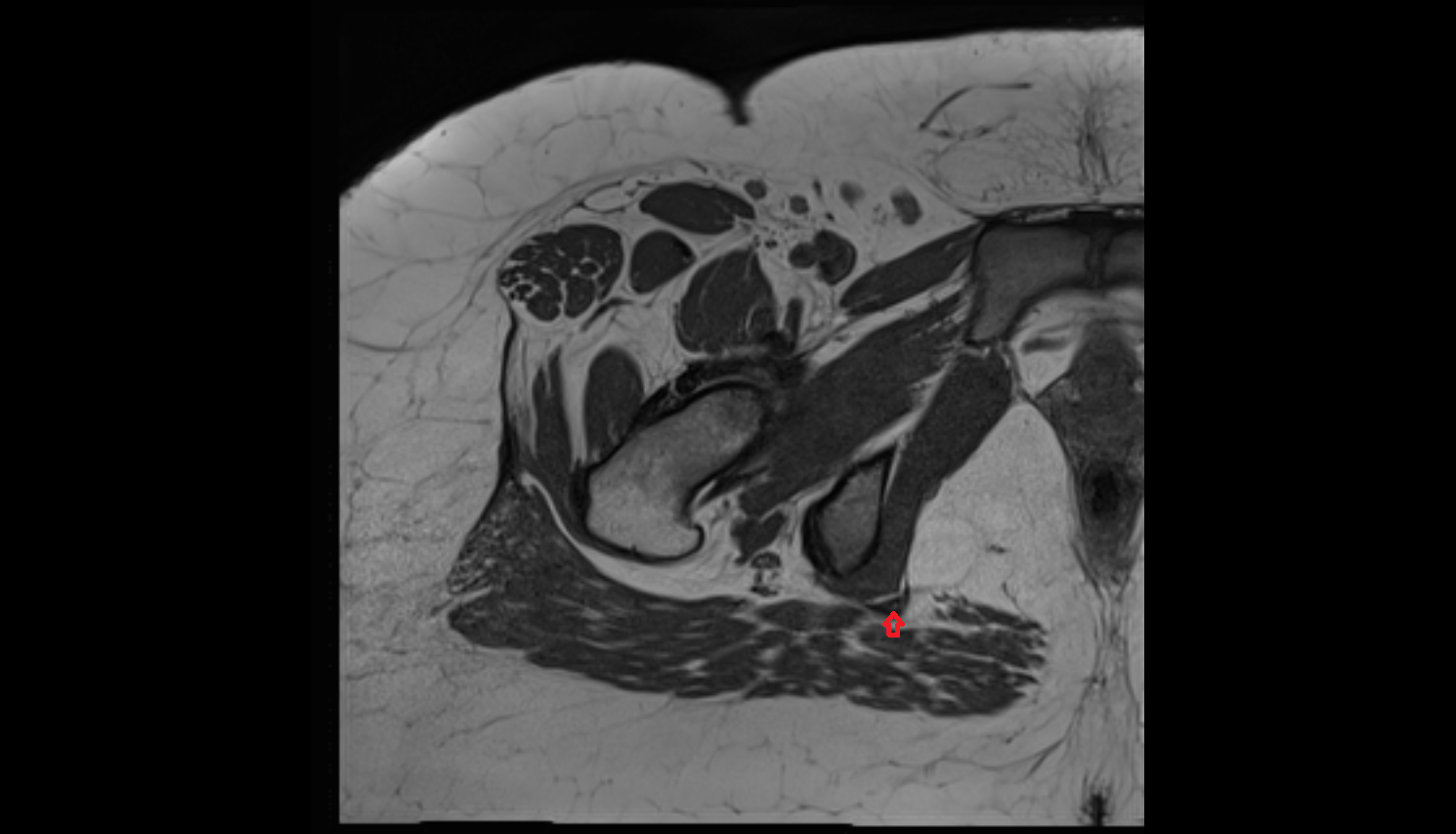 Sacrotuberous ligament  MRI axial image-img-00000-00000
