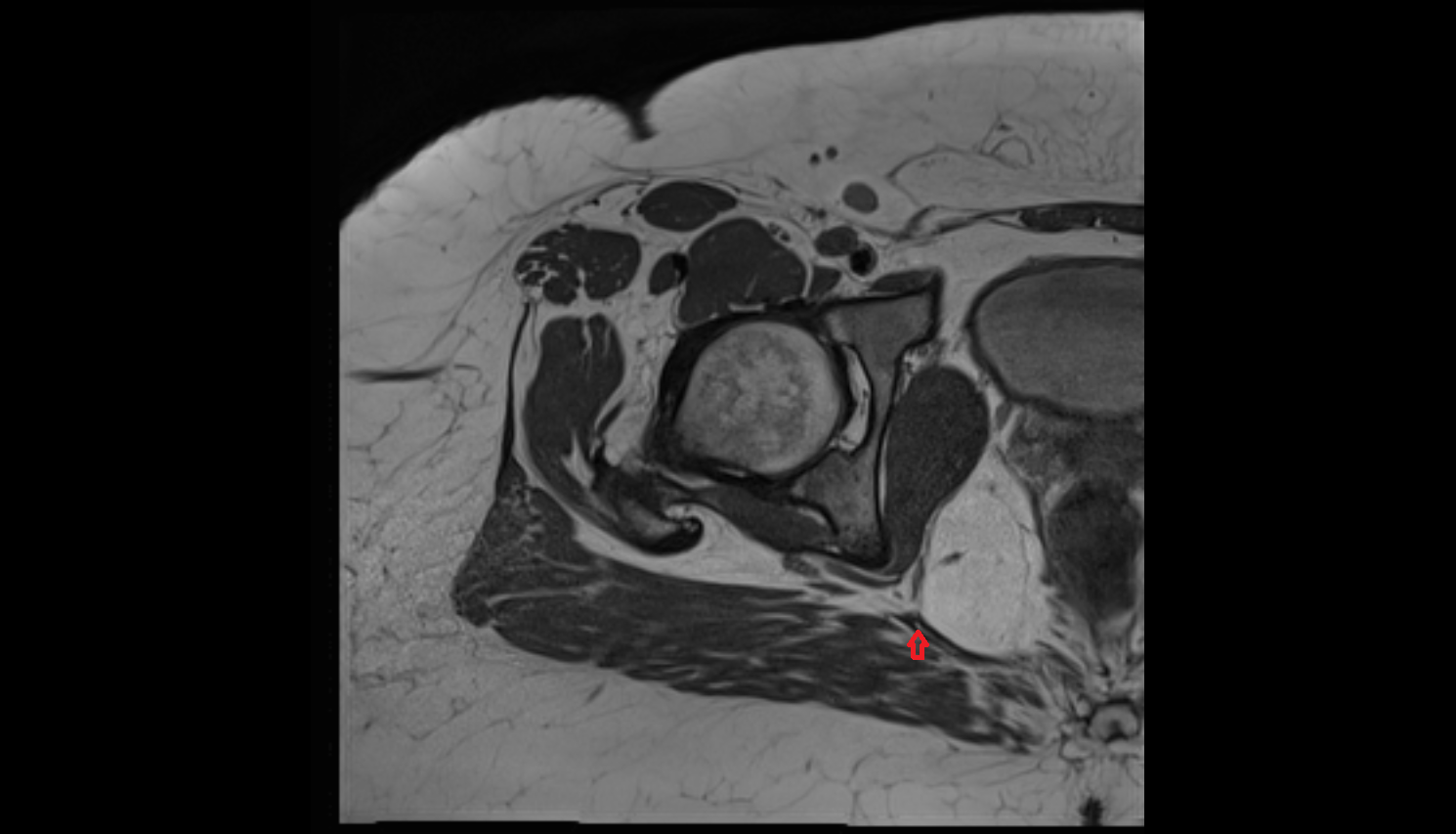 Sacrotuberous ligament  MRI axial image-img-00000-00000_00001