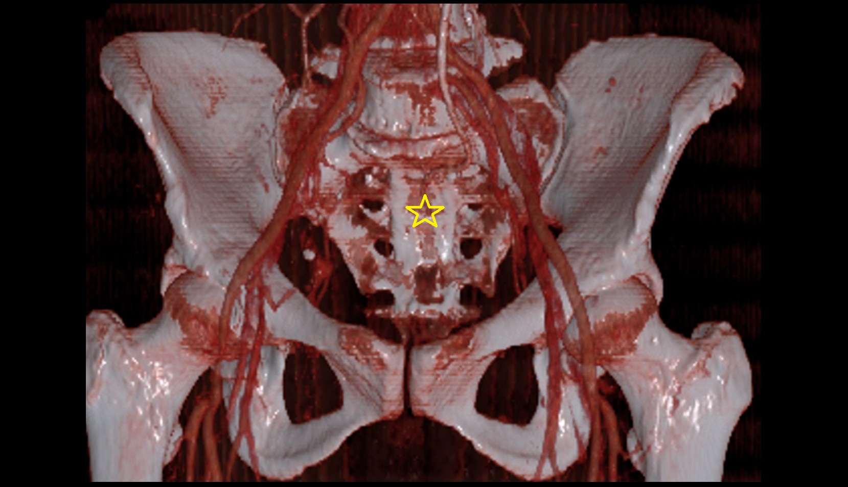 Sacrum  CT VRT  coronal image