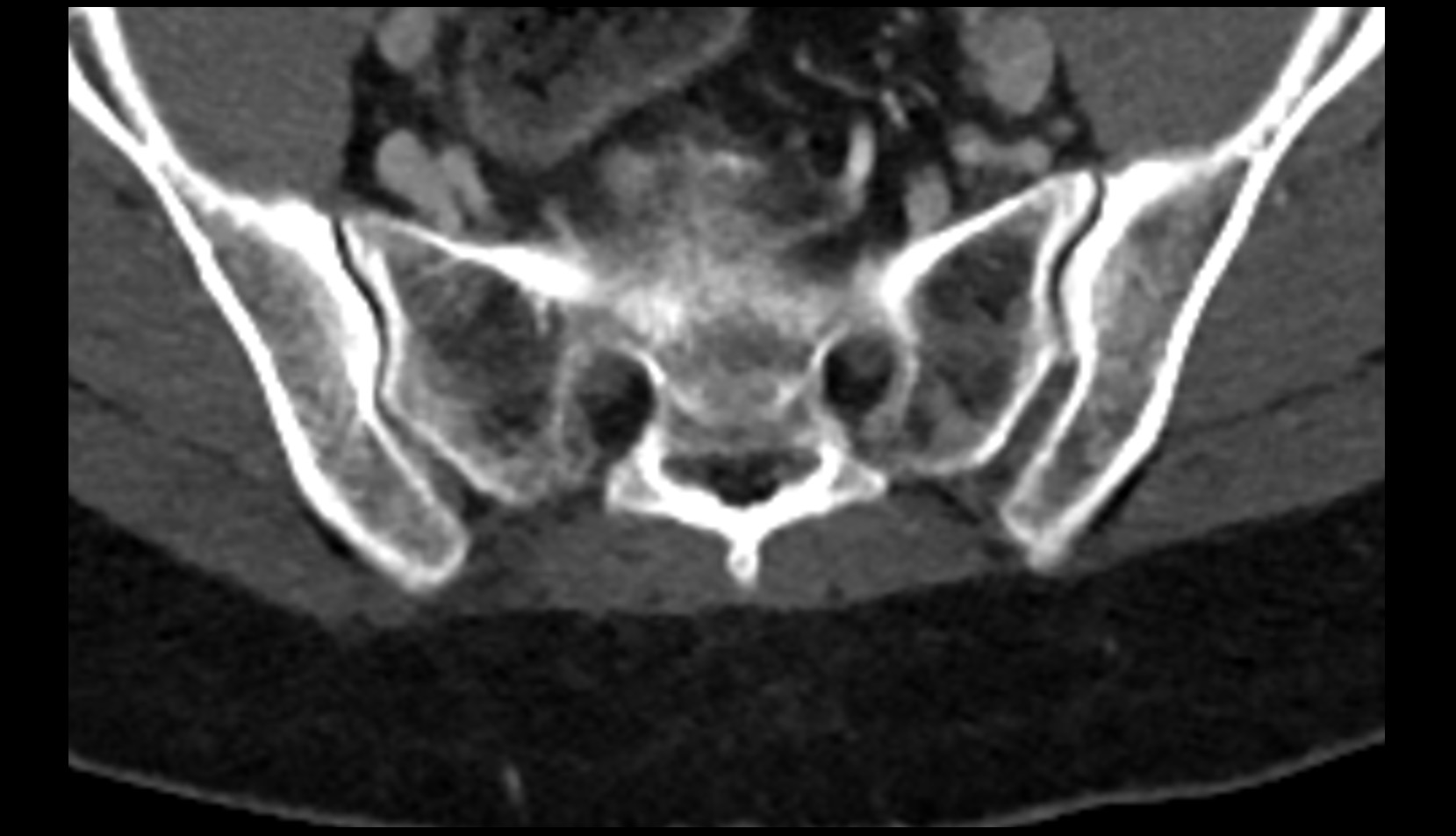 Sacrum CT axial image