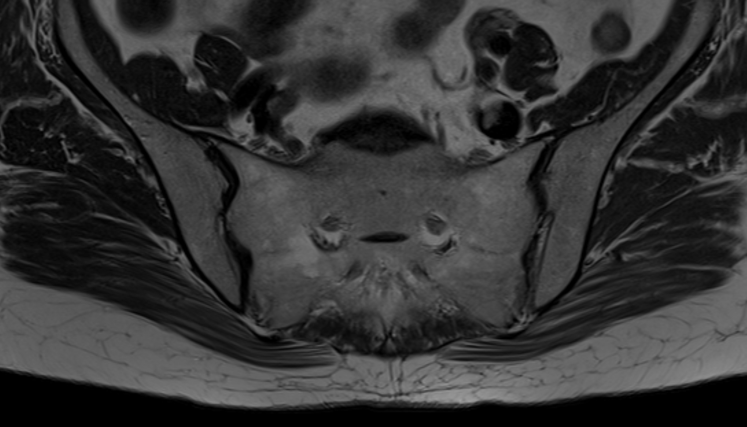 Sacrum   MRI axial anatomy  image -img-00000-00000