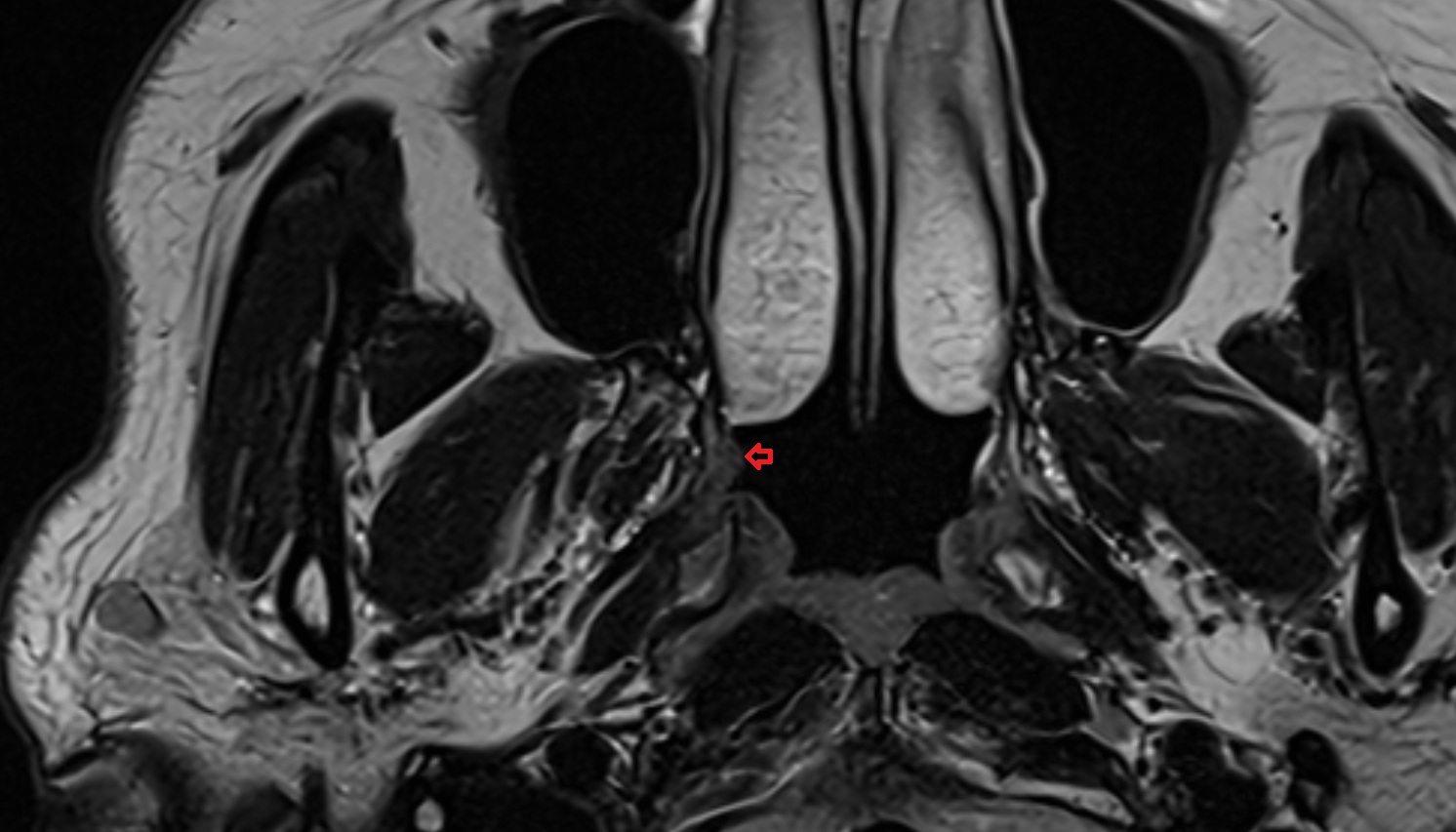 Salpingopalatine fold mri axial image -img-00000-00000