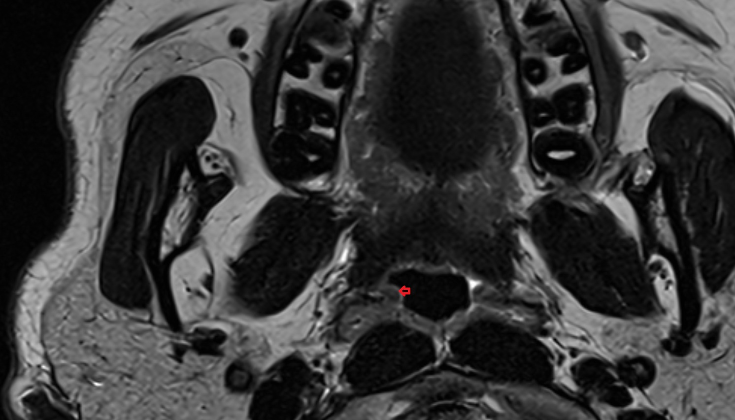 Salpingopharyngeal fold mri axial image -img-00000-00000