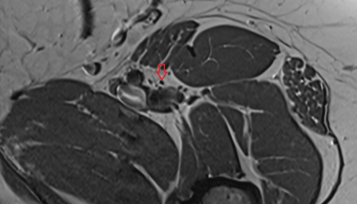 Saphenous Nerve  MRI axial  image  image anatomy  image-img-00000-00000_00003