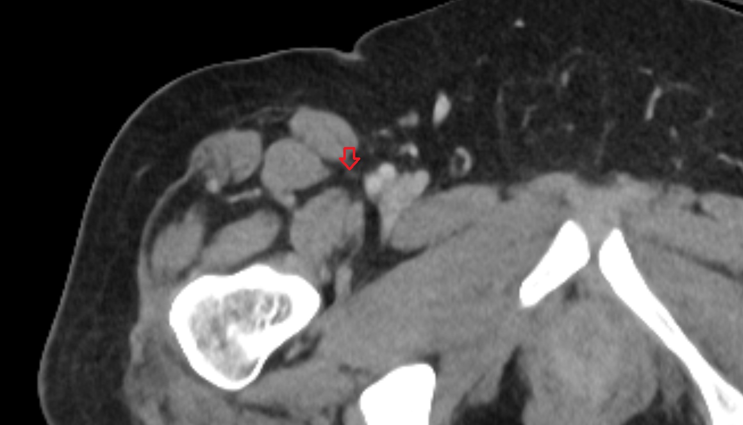 Saphenous Nerve  ct  axial  image  image anatomy  image-img-00000-00000