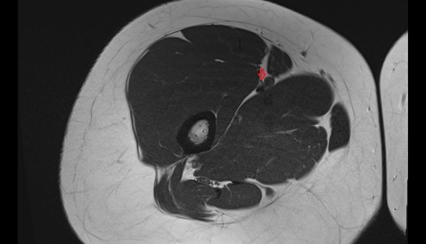 Saphenous nerve  MRI axial  anatomy image-img-00000-00000