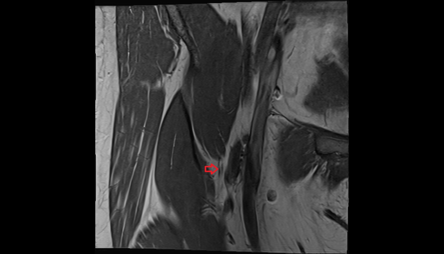 Saphenous nerve  MRI coronal  anatomy image-img-00000-00000