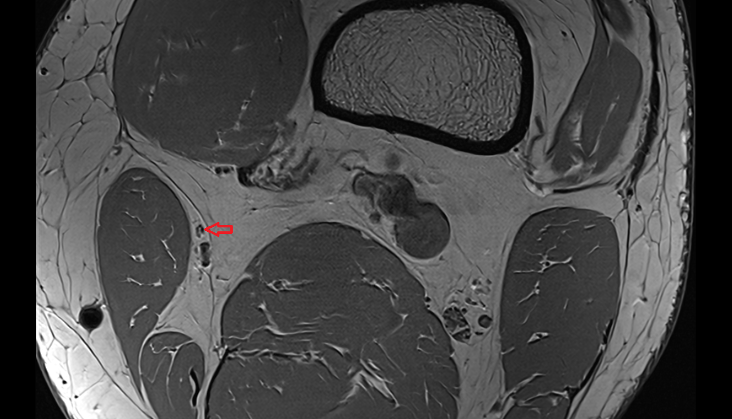 Saphenous nerve axial  cross sectional anatomy 3T MRI AI enhanced  radiology  anatomy image-img-00000-00000