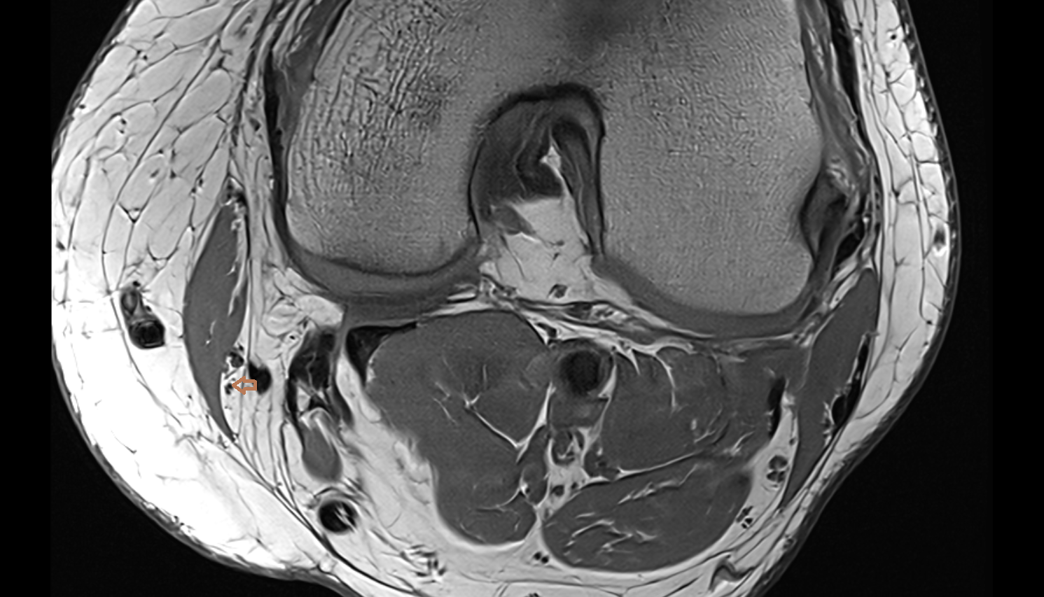 Saphenous nerve axial  cross sectional anatomy 3T MRI AI enhanced  radiology  anatomy image-img-00000-00000_00001