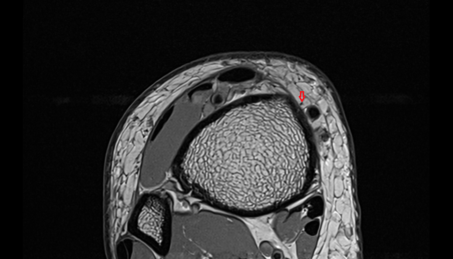 Saphenous nerve axial cross sectional anatomy 3T MRI AI enhanced radiology image-img-00000-00000