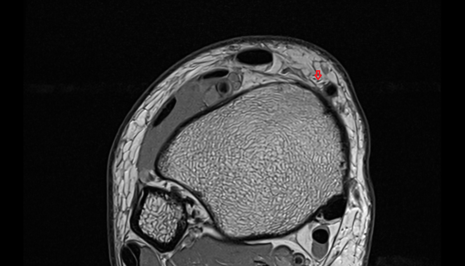 Saphenous nerve axial cross sectional anatomy 3T MRI AI enhanced radiology image-img-00000-00000_00001