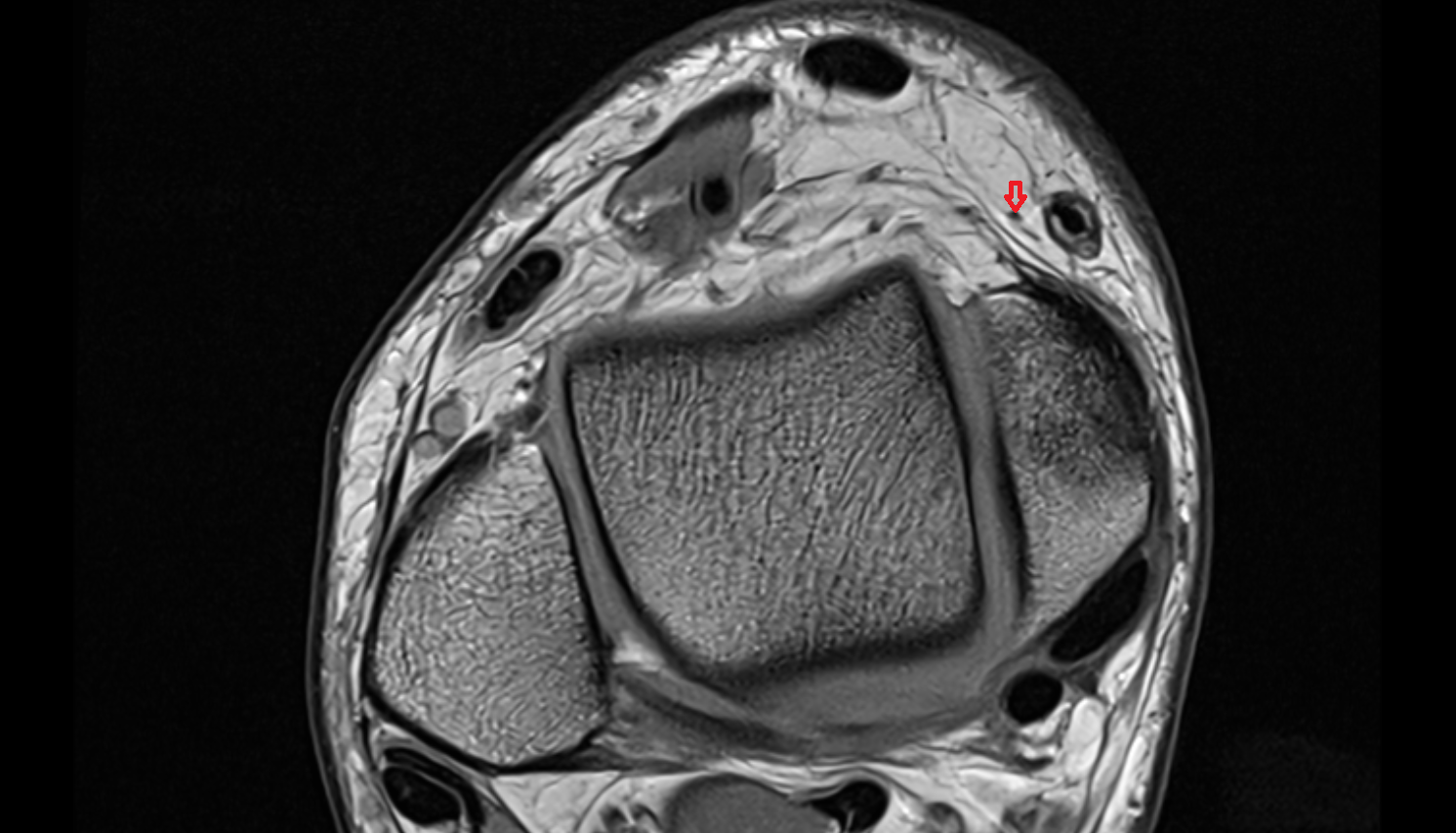 Saphenous nerve axial cross sectional anatomy 3T MRI AI enhanced radiology image-img-00000-00000_00002