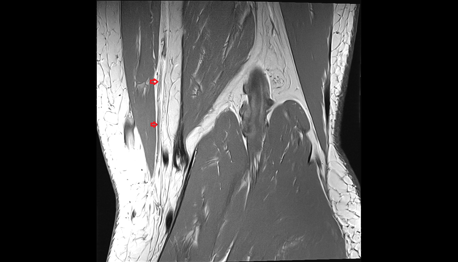 Saphenous nerve coronal  cross sectional anatomy 3T MRI AI enhanced  radiology  anatomy image-img-00000-00000
