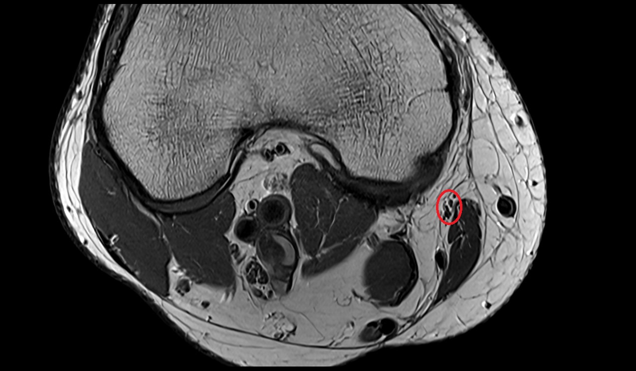 Saphenous nerve mri image