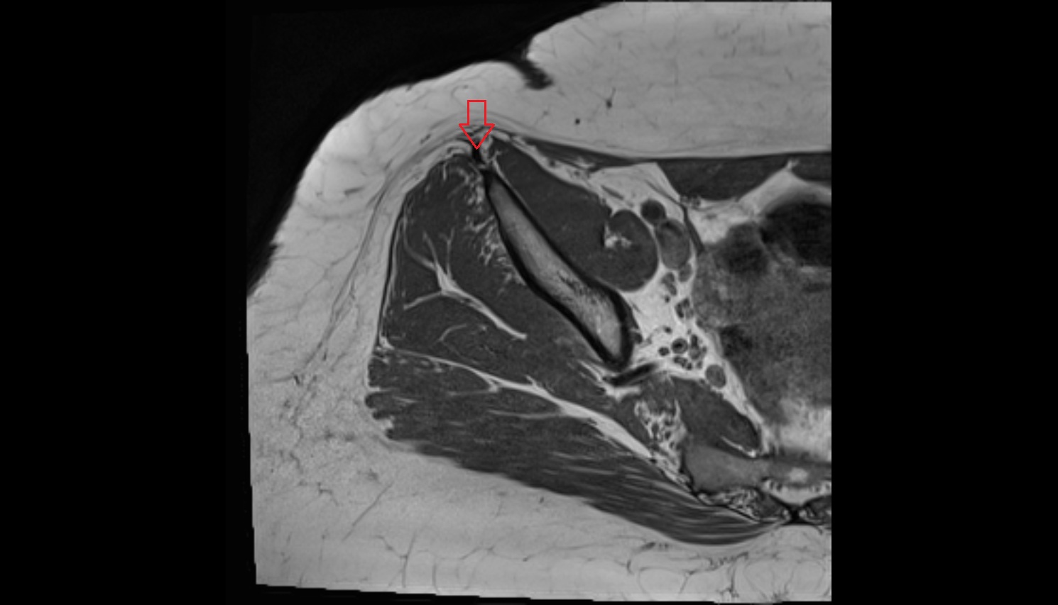 Sartorius Tendon (Proximal)  MRI axial anatomy image-img-00000-00000