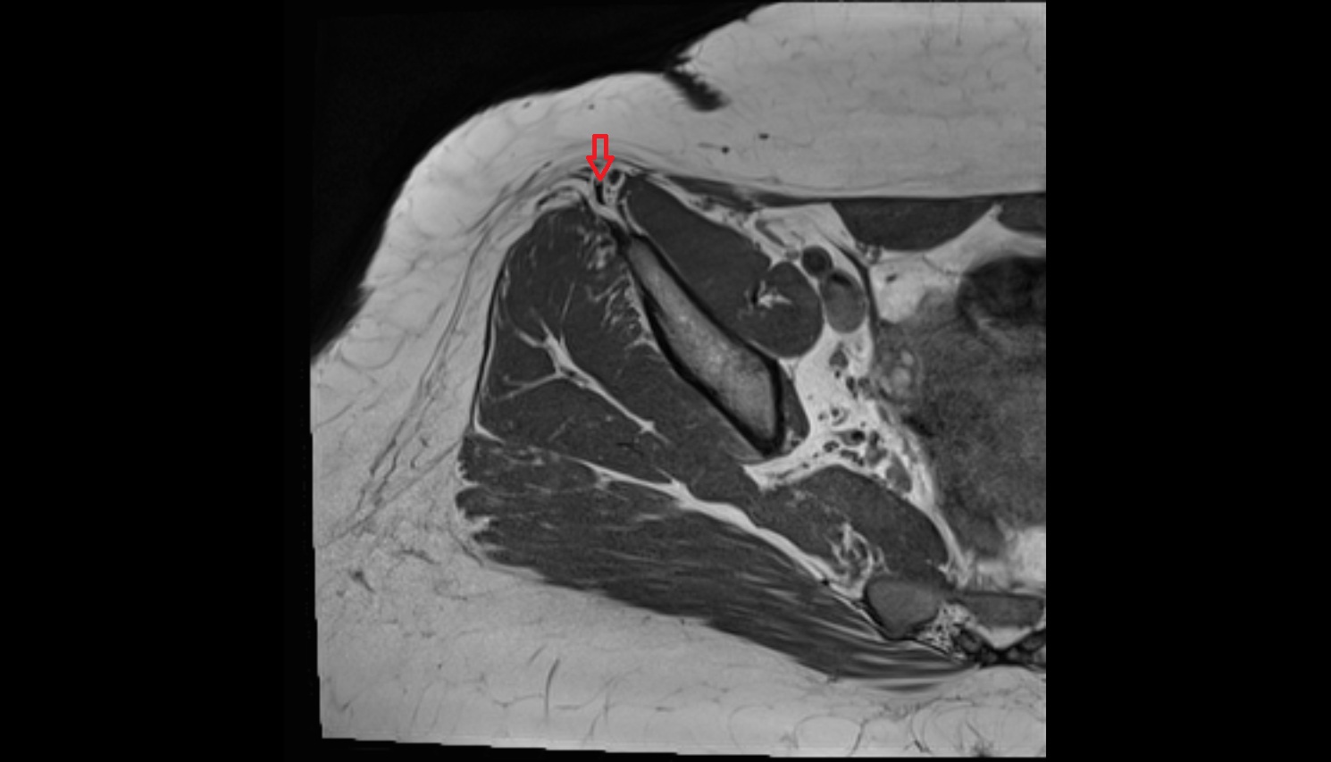 Sartorius Tendon (Proximal)  MRI axial anatomy image-img-00000-00000_00001