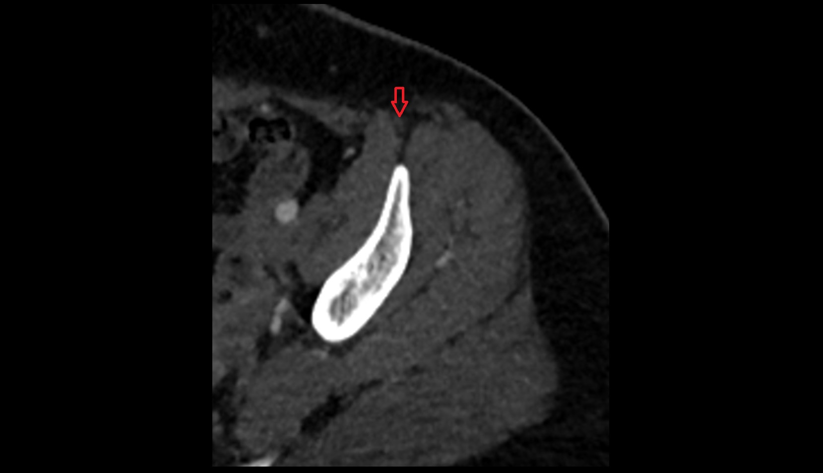 Sartorius Tendon (Proximal)  CT axial anatomy