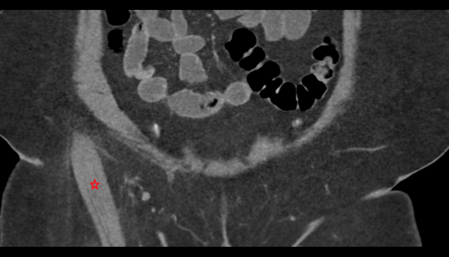 Sartorius muscle CT  CORONAL   anatomy  image-img-00000-00000