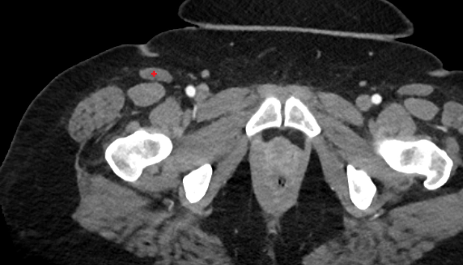 Sartorius muscle CT  axial   anatomy  image-img-00000-00000_00001