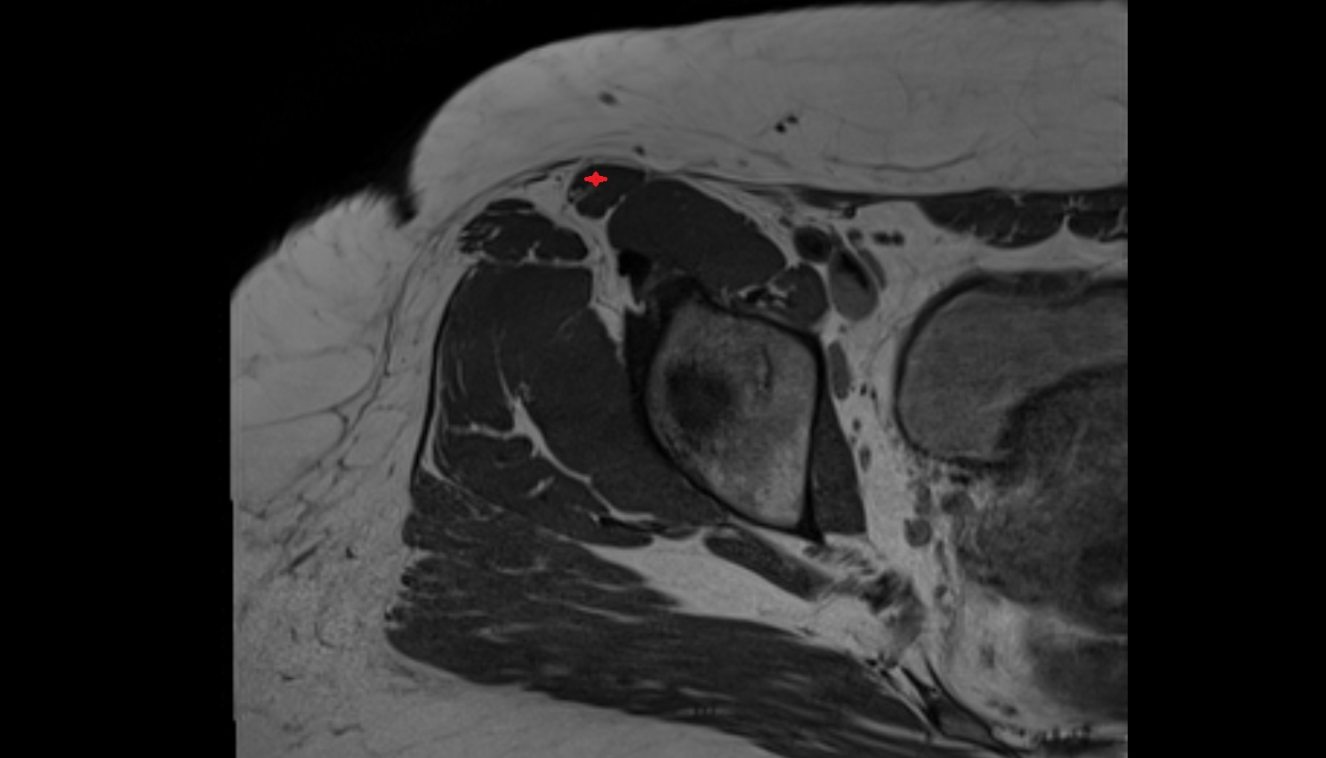 Sartorius muscle MRI  axial   anatomy  image-img-00000-00000