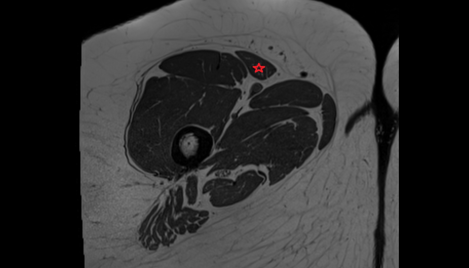 Sartorius muscle MRI  axial   anatomy  image-img-00000-00000_00002
