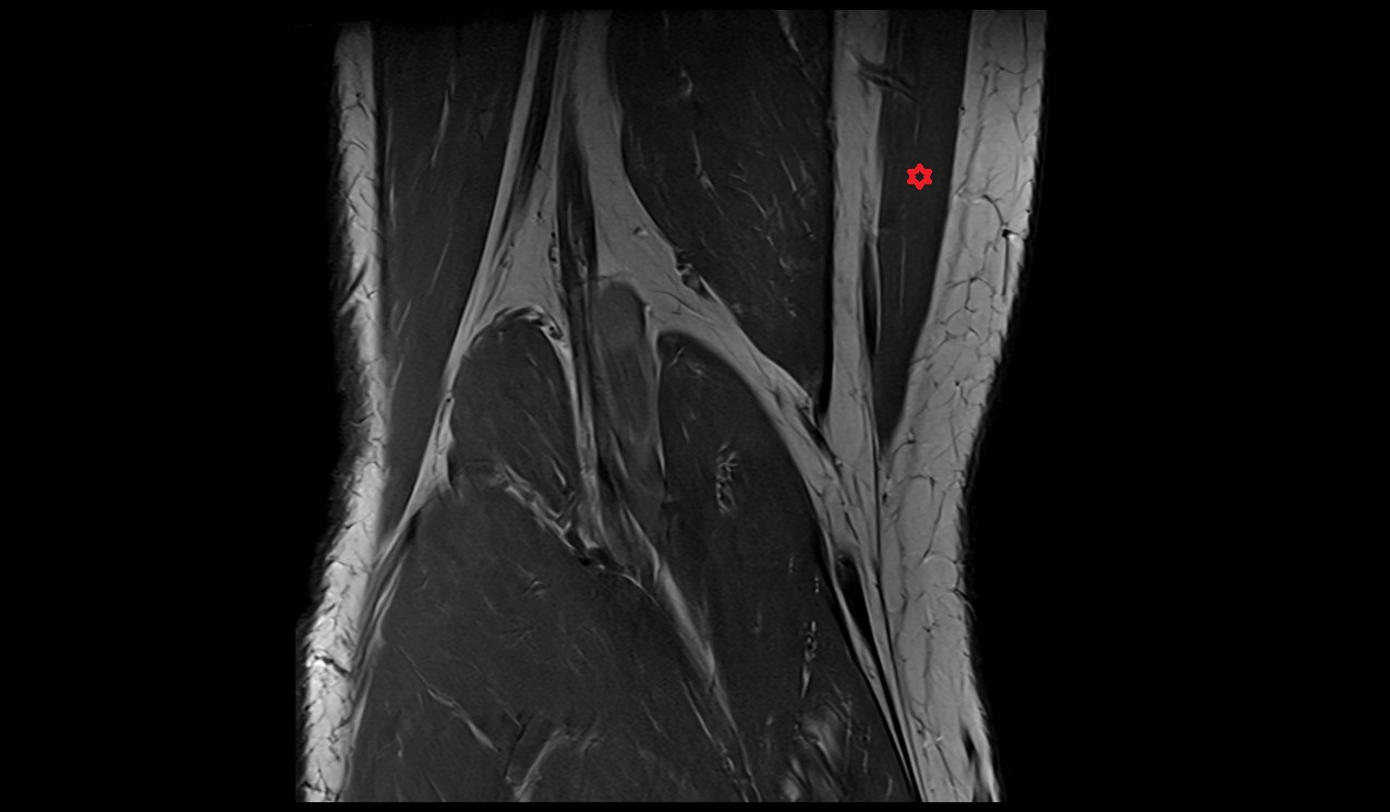 Sartorius muscle mri image