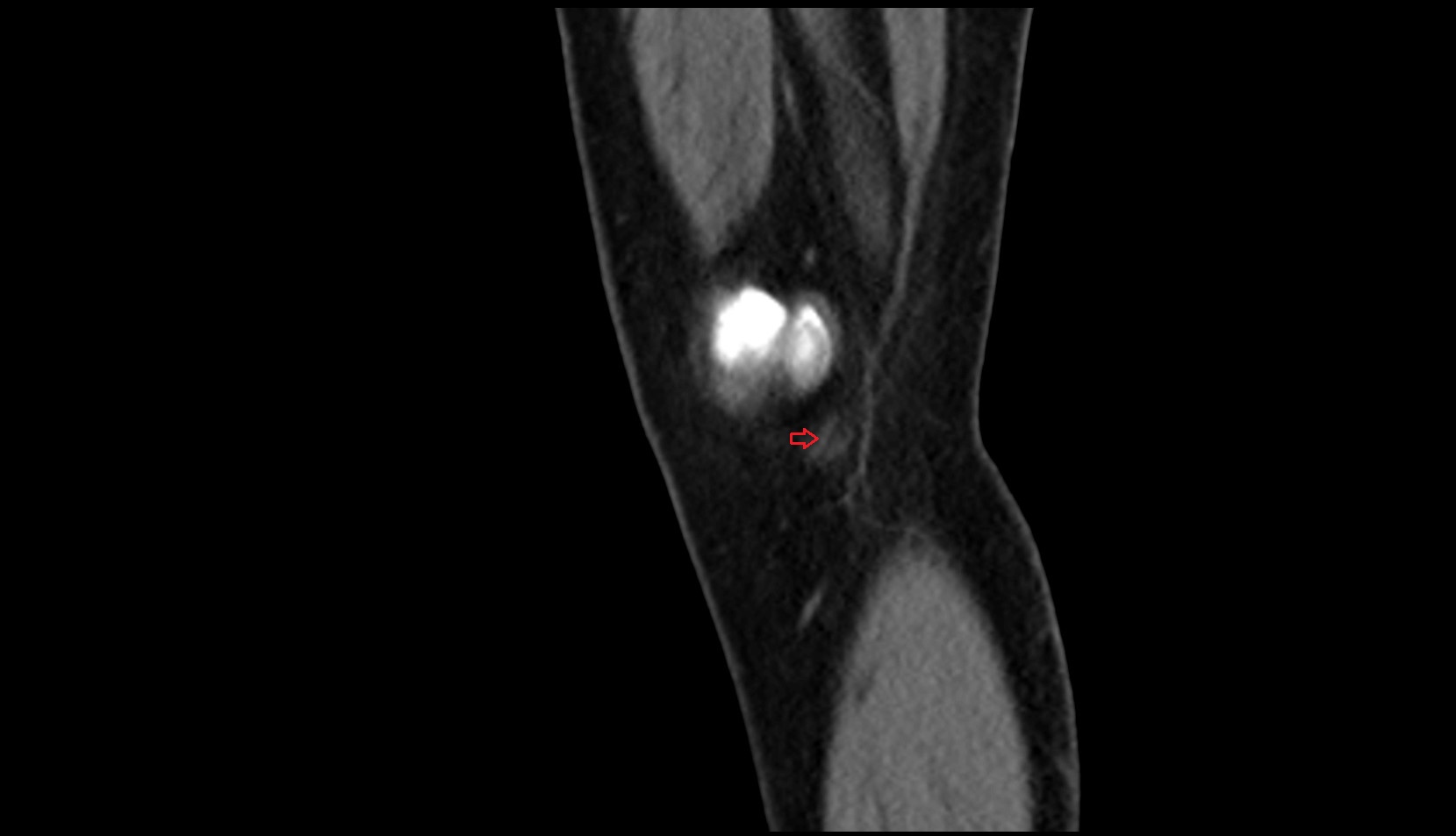 Sartorius tendon (Distal)