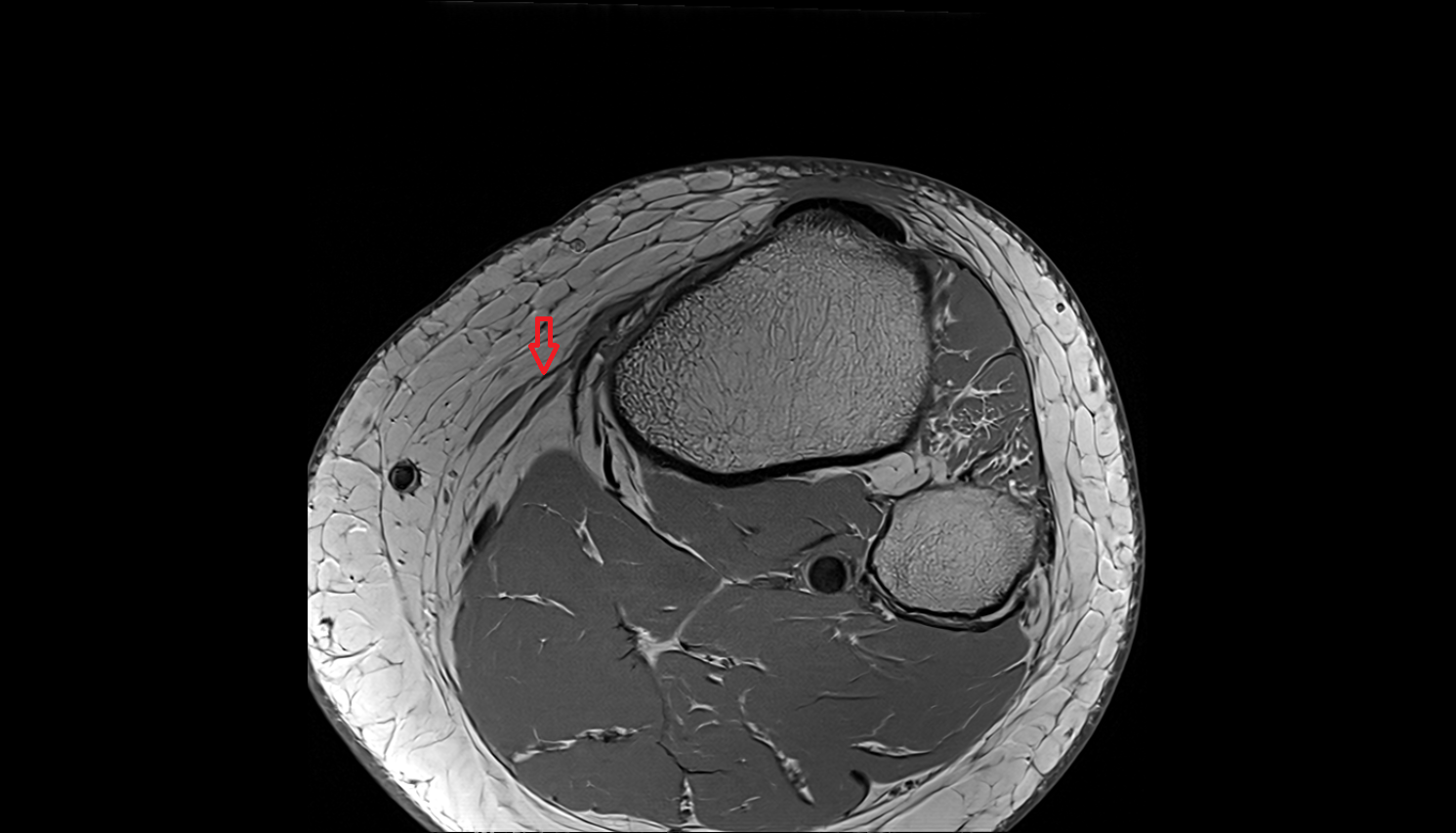 Sartorius tendon (Distal) axial  cross sectional anatomy 3T MRI AI enhanced  radiology  anatomy image-img-00000-00000