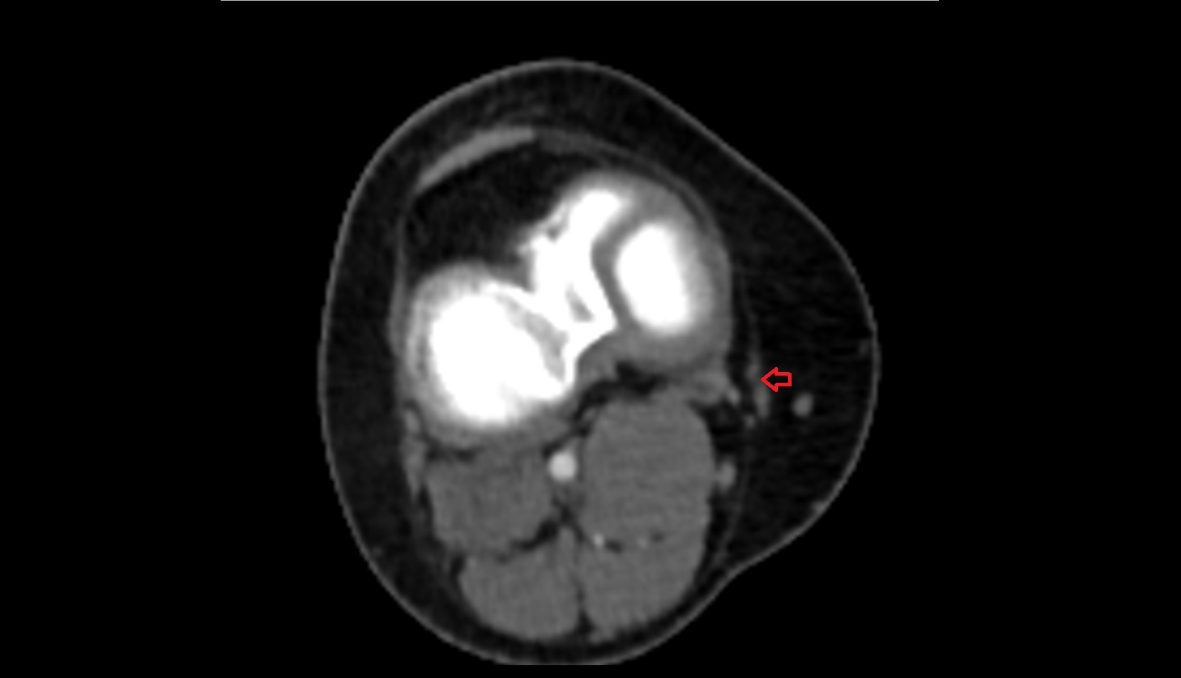 Sartorius tendon (Distal) ct axial image