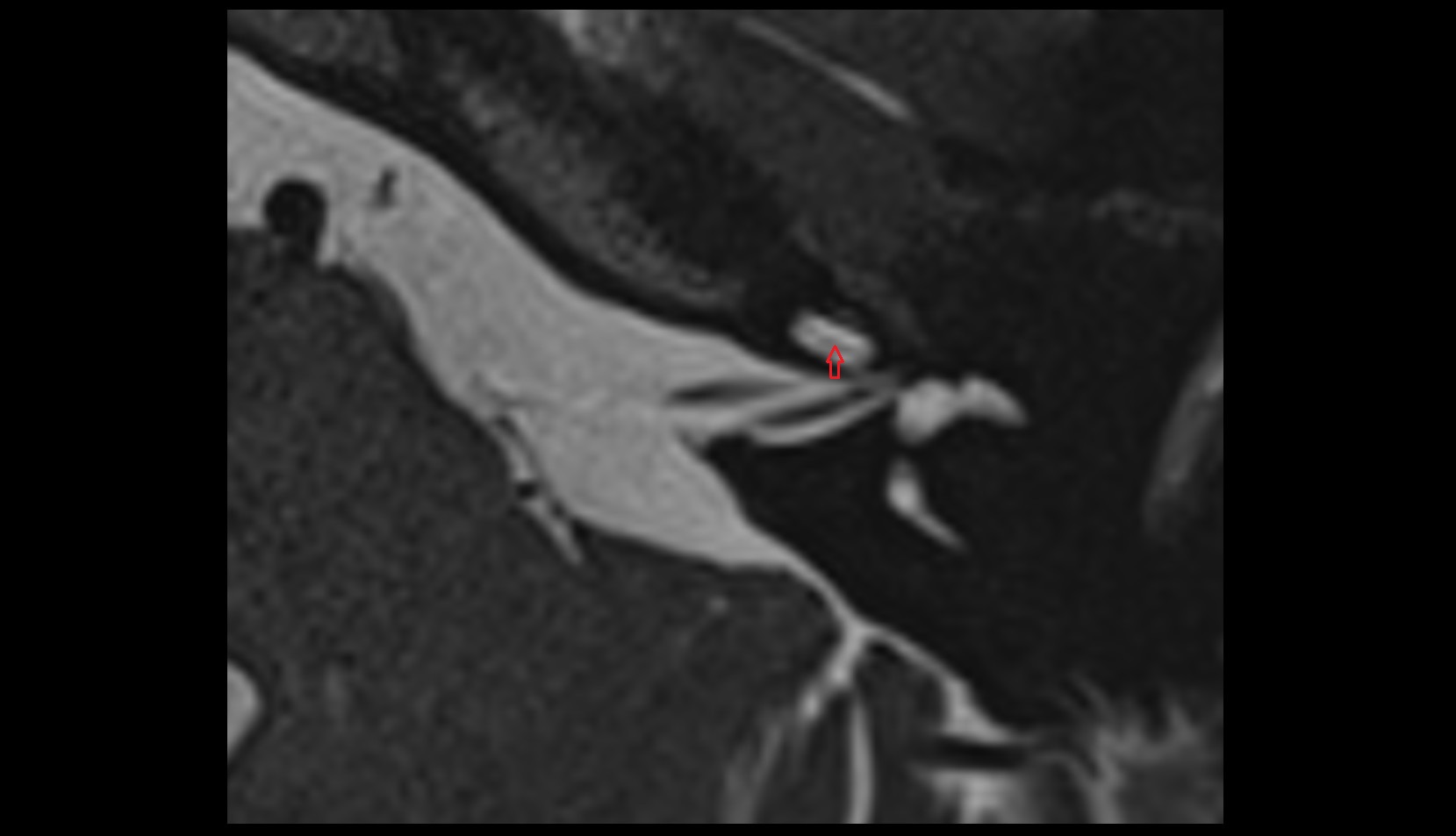 Scala media MRI axial image