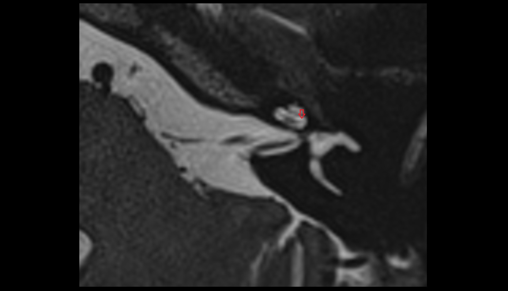 Scala vestibuli MRI axial image