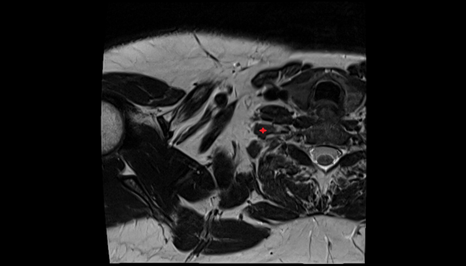 Scalenus medius muscle (middle scalene muscle)  MRI  axial  image -img-00000-00000