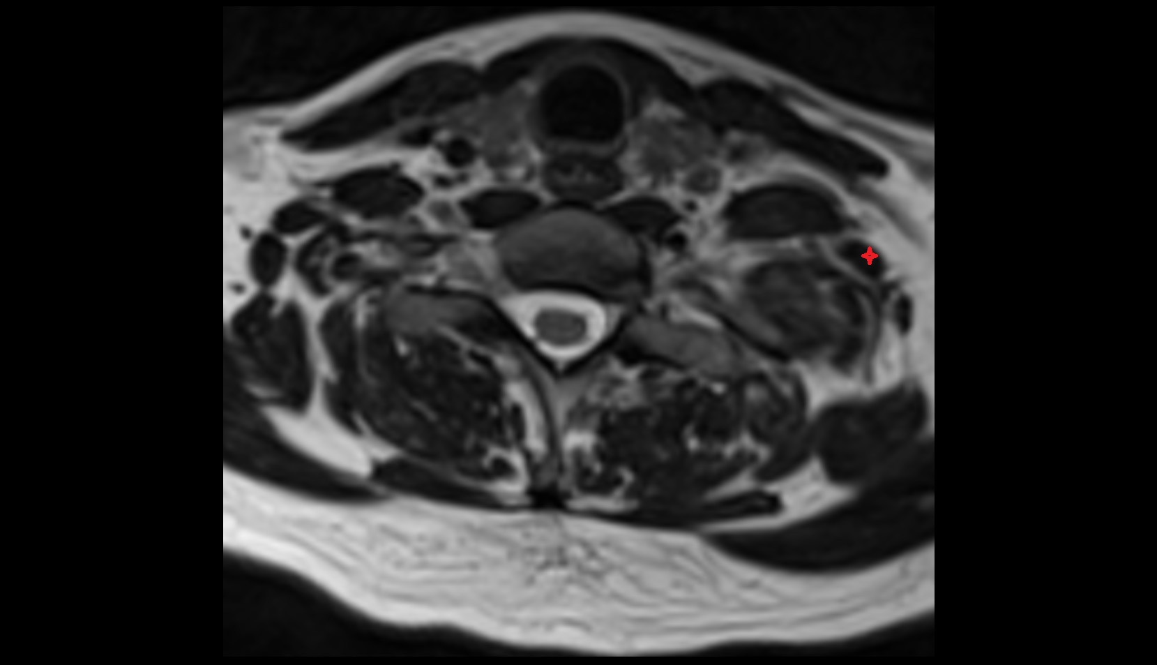 Scalenus medius muscle mri image
