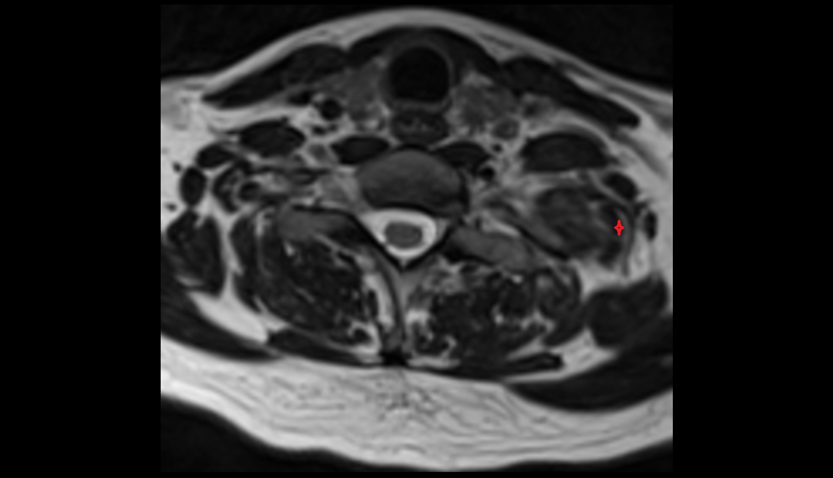 Scalenus posterior muscle mri image