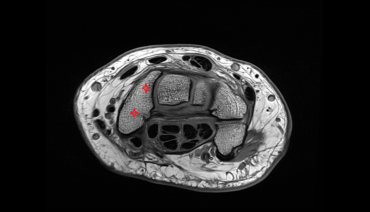Scaphoid axial cross sectional anatomy 3T MRI AI enhanced radiology image-img-00000-00000