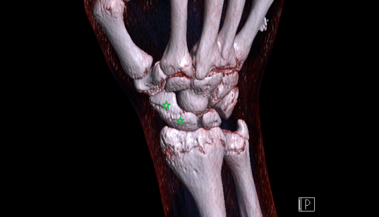 Scaphoid bone CT 3D VRT image -img-00000-00000