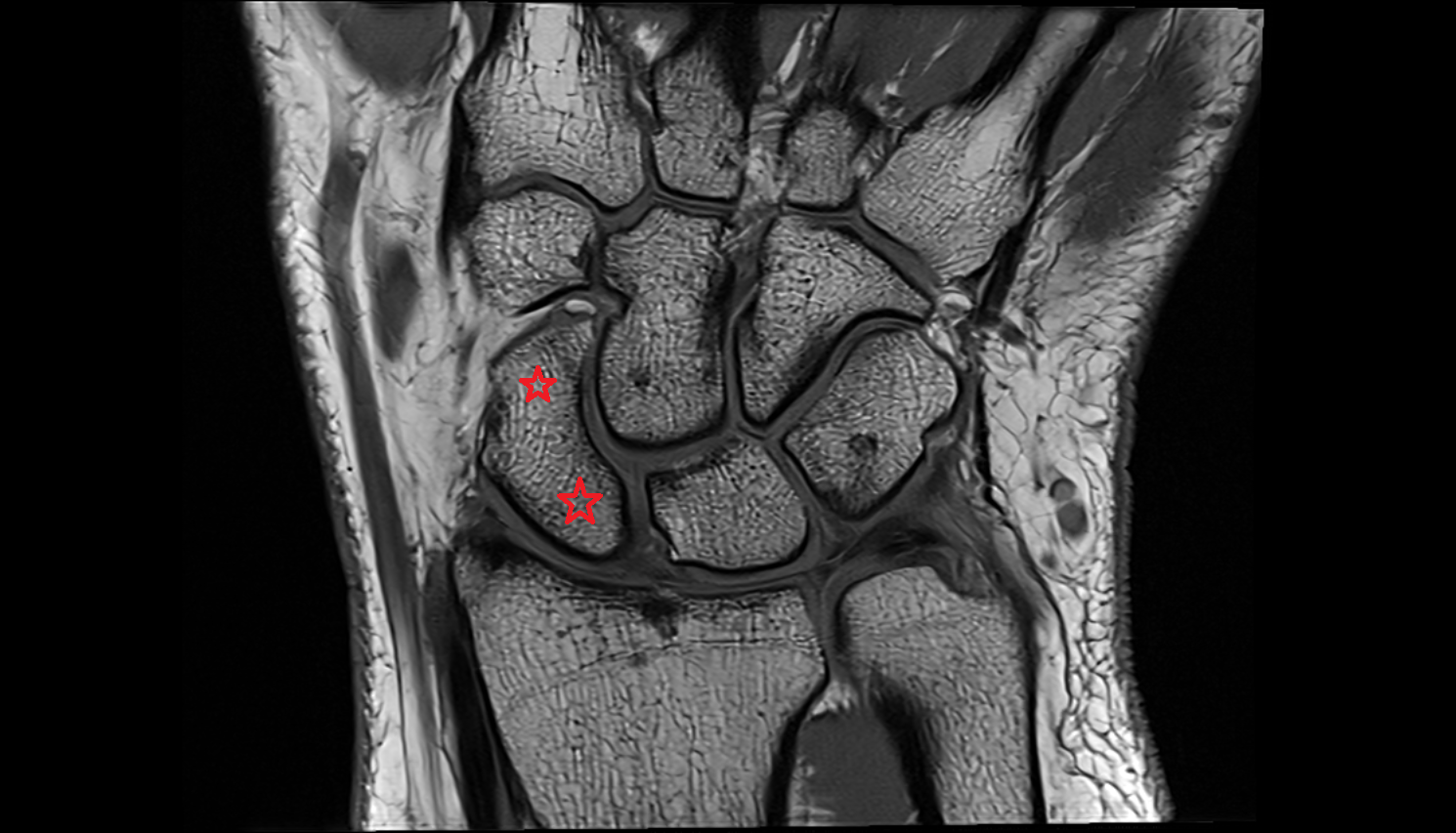 Scaphoid coronal cross sectional anatomy 3T MRI AI enhanced radiology image-img-00000-00000